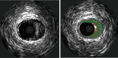 Value of intravascular ultrasound (IVUS)