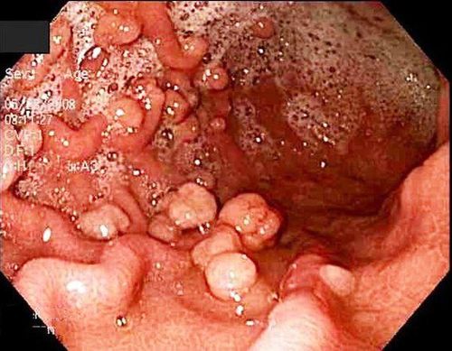 Các loại đa polyp gia đình (FAP) thường gặp