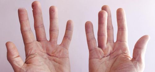 Dupuytren's contracture (palm scale): What you need to know