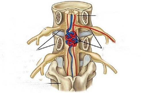 
Dị dạng mạch máu tủy sống cần được chẩn đoán phân biệt tránh nhầm lẫn với bệnh lý khác
