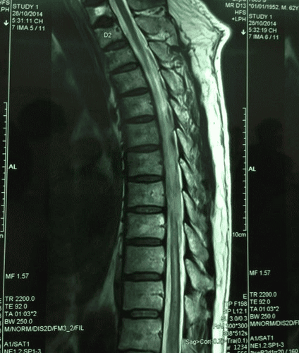 
MRI nhồi máu tủy sống
