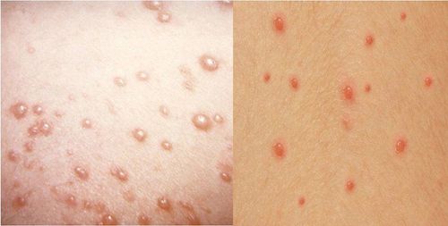 Differentiate between chickenpox and hand, foot and mouth disease in children