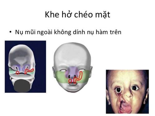 Deformity of cross-facial cleft on both sides