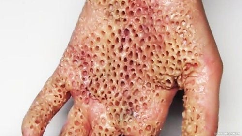 Hội chứng sợ lỗ tròn (Trypophobia): Những điều cần biết