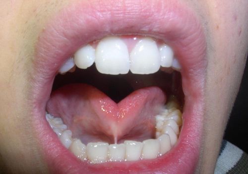 Ankyloglossia: Causes, symptoms