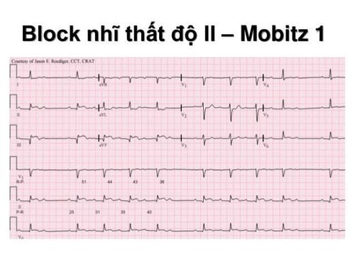 
Hình ảnh block nhĩ nhất độ 2
