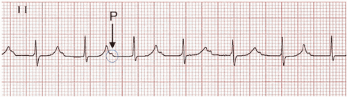 What is atrioventricular block? Things to know about atrioventricular block