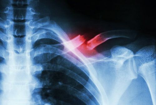 X-ray image of clavicle fracture