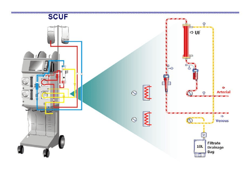 
Hình ảnh máy lọc máu trong siêu lọc máu chậm liên tục (SCUF)
