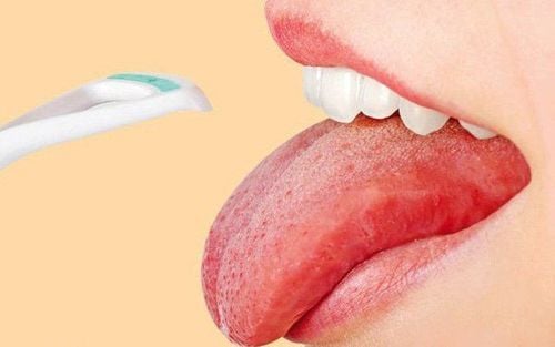 Trên lưỡi có một vách nứt nhỏ và một vết loét hình tròn có phải triệu chứng của ung thư lưỡi hay viêm lưỡi bản đồ?