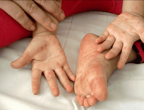 Can a blood test detect hand, foot and mouth disease?