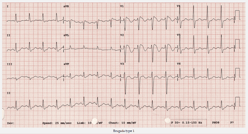 Brugada syndrome: Diagnosis and treatment