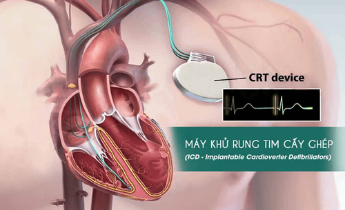 
Máy khử rung tim cấy ghép là một kỹ thuật trong điều trị hội chứng Brugada
