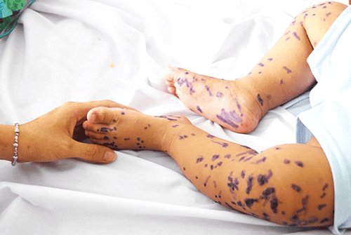 Applying methylene blue solution also has the effect of reducing complications of chickenpox