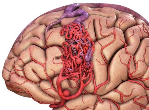 Warning signs of cerebrovascular malformation (AVM)