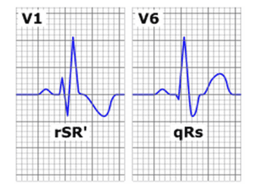 Find out the phenomenon of right bundle branch block in the heart