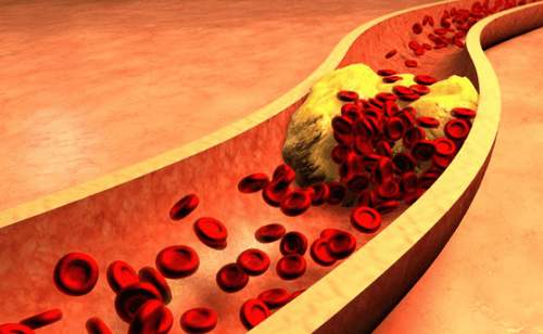 Cholesterol trong máu tăng cao được coi là nguyên nhân dẫn đến bệnh tiểu đường