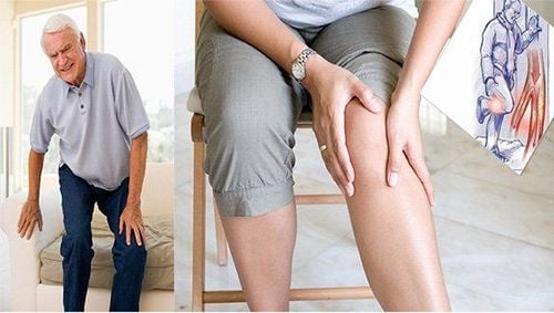 
Bệnh giả Gout gây dưng khớp
