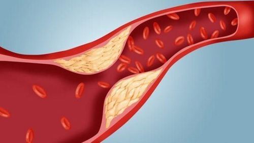 
Xét nghiệm cholesterol hoàn chỉnh đo bốn loại lipid hoặc chất béo trong máu là: Cholesterol toàn phần, Cholesterol lipoprotein mật độ thấp (LDL), Cholesterol lipoprotein mật độ cao (HDL) và Triglyceride
