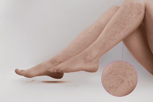 Will varicose veins in the legs leave complications if surgery?