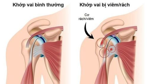 
Viêm quanh khớp vai do nhiều nguyên nhân khác nhau gây ra thường gặp lứa tuổi trên 50
