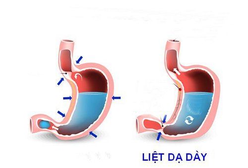 
Hình ảnh dạ dày bình thường và liệt dạ dày
