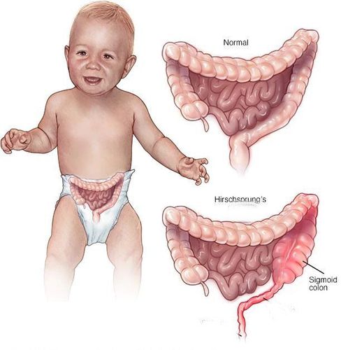 
Bệnh Hirschsprung ở trẻ gây giãn đại tràng
