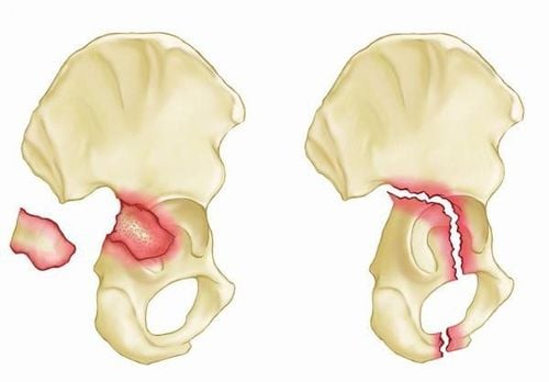 Gãy xương chậu, tổn thương dây thần kinh, bàn chân không gập lên xuống được đã 6 tháng có thể điều trị được nữa không?