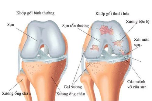 Tại sao sụn khớp bị bào mòn lão hóa?