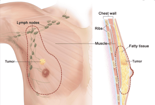 Những điều cần biết khi đàn ông mắc ung thư vú (breast cancer in men) - Phần 1