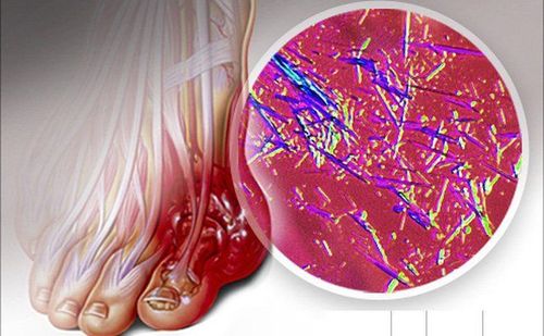 Impaired purine metabolism and hyperacidity