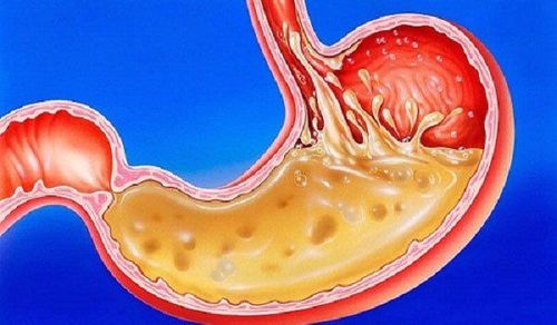 
Nồng độ pH dạ dày thực quản có ảnh hưởng đến tình trạng ở chua của người bệnh GERD
