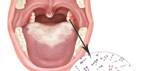 Recommendations against diphtheria from the Ministry of Health