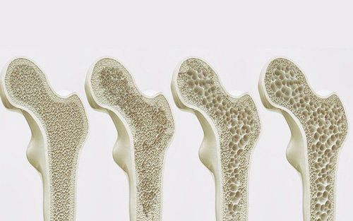 Treatment of osteoporosis in people with diabetes