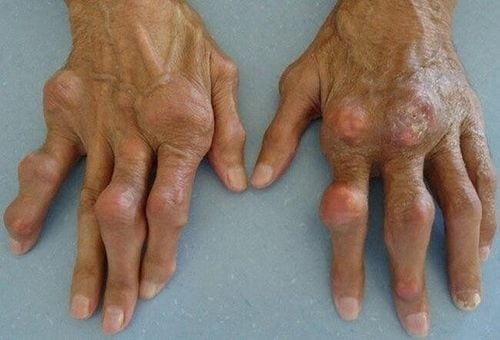 
Bệnh gout kéo dài sẽ chuyển sang mãn tính và gây ra biến chứng
