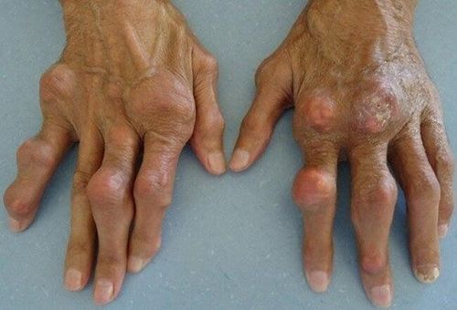 
Hình ảnh bàn tay của bệnh nhân mắc bệnh gout
