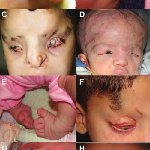 Hội chứng Fraser là một rối loạn về di truyền gây ra dị tật bẩm sinh ở trẻ