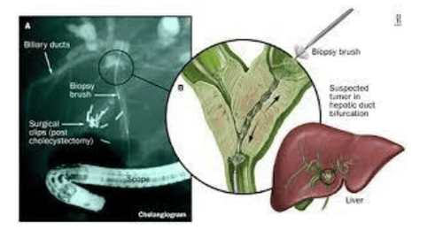 
U ngã ba đường mật, được chẩn đoán bằng hình ảnh Xquang/ ERCP
