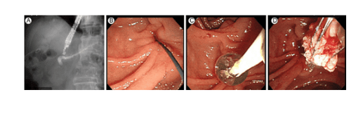 
ERCP lấy sỏi tuỵ
