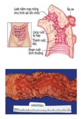 
Hình 2: Hình ảnh minh hoạ bệnh Crohn gây ảnh hưởng toàn bộ thành ống tiêu hoá và hình ảnh thực tế một bệnh nhân được phẫu thuật điều trị bệnh Crohn
