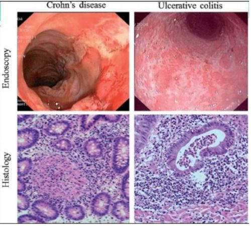 
Hinh 3: Hình ảnh nội soi và mô bệnh học của bệnh Crohn (bên trái) và bệnh viêm loét đại tràng (bên phải)
