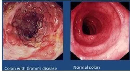 
Hình 3: Hình ảnh nội soi: đại tràng bị bệnh Crohn (hình bên trái) và hình ảnh đại tràng bình thường (hình bên phải)
