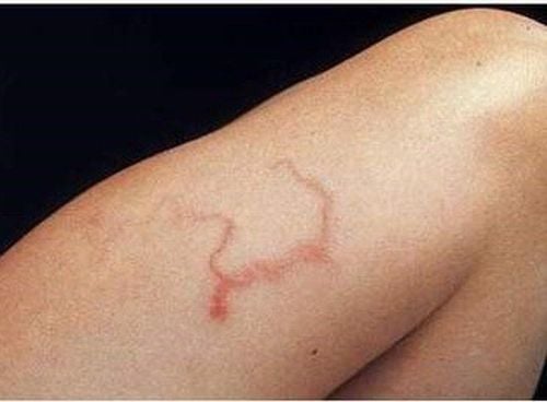 Complications caused by strongyloidiasis