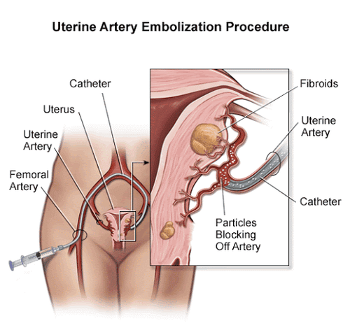 Advantages of uterine fibroids treatment by uterine artery embolization