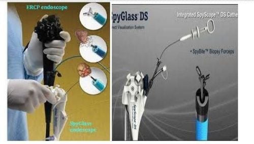 
Dụng cụ SpyGlass: Một ống soi nhỏ, đường kính khoảng 2.8mm được đưa qua kênh thủ thuật của dây soi ERCP, đưa vào đường mật
