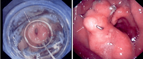 Role of OTSC clip in gastrointestinal tract disease