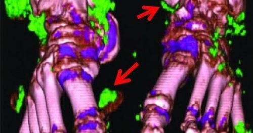 Chụp cắt lớp vi tính 2 mức năng lượng là gì?