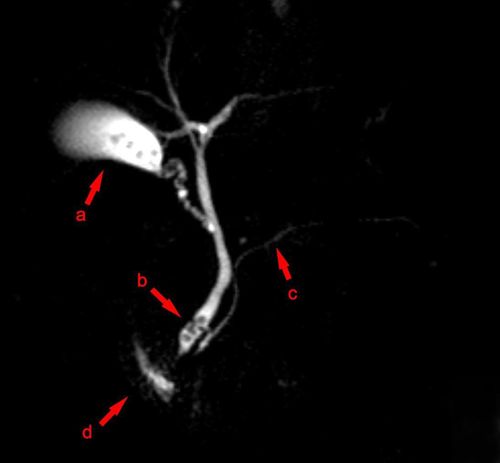 Imaging of biliary tract disease on MRI