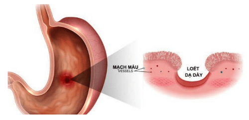 
Hình 2: Loét dạ dày, bệnh lý ngày càng phổ biến trong cuộc sống hiện nay
