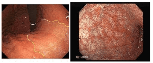 
Hình 4: Viêm teo niêm mạc dạ dày – hậu quả của nhiễm H.Pylori
